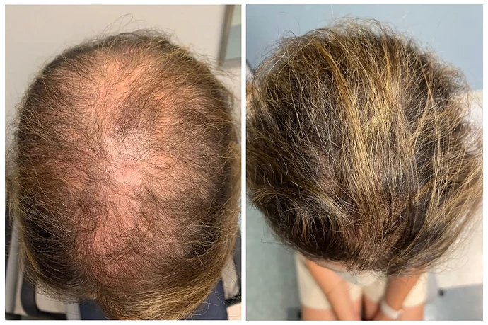 18sci-hairloss-superJumbo.jpg