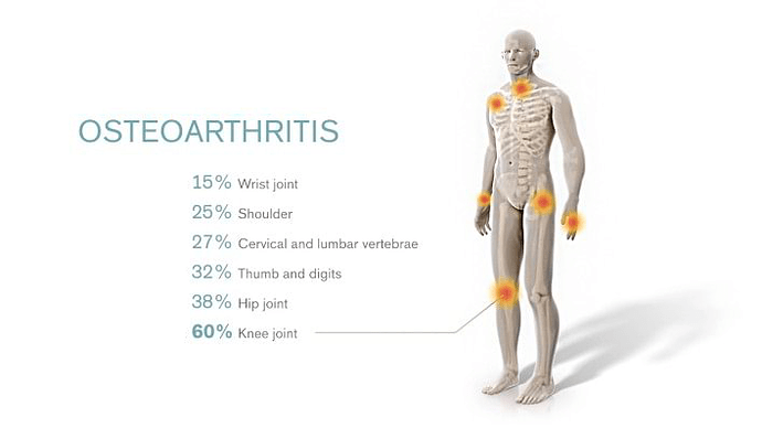 osteoarthritis2c