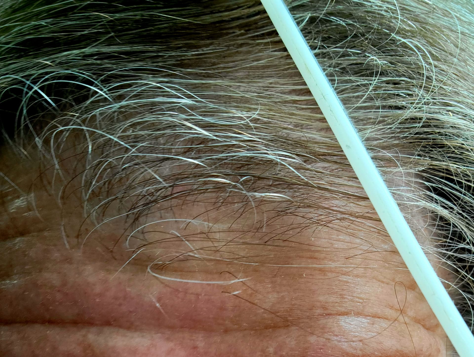 Grey Hair turning Black again after 10 years - Rapamycin Longevity News